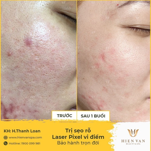 Trị sẹo rỗ bằng Laser Pixel siêu vi điểm tại Phòng Khám Da Liễu HHV Clinic