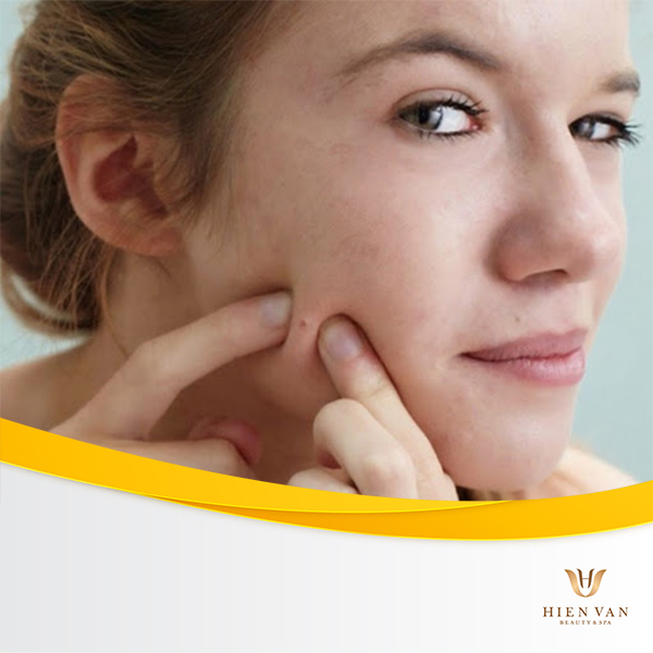 Tự nặn mụn không đúng cách dẫn đến sẹo