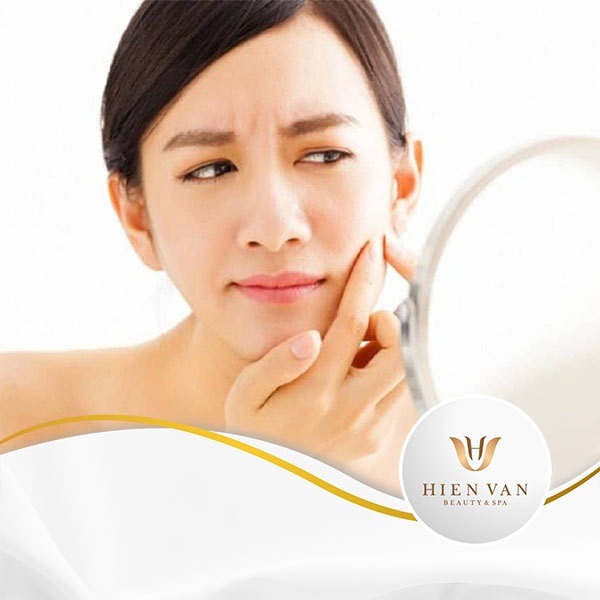 Làm sao để làn da không còn sần sùi vì mụn cám?