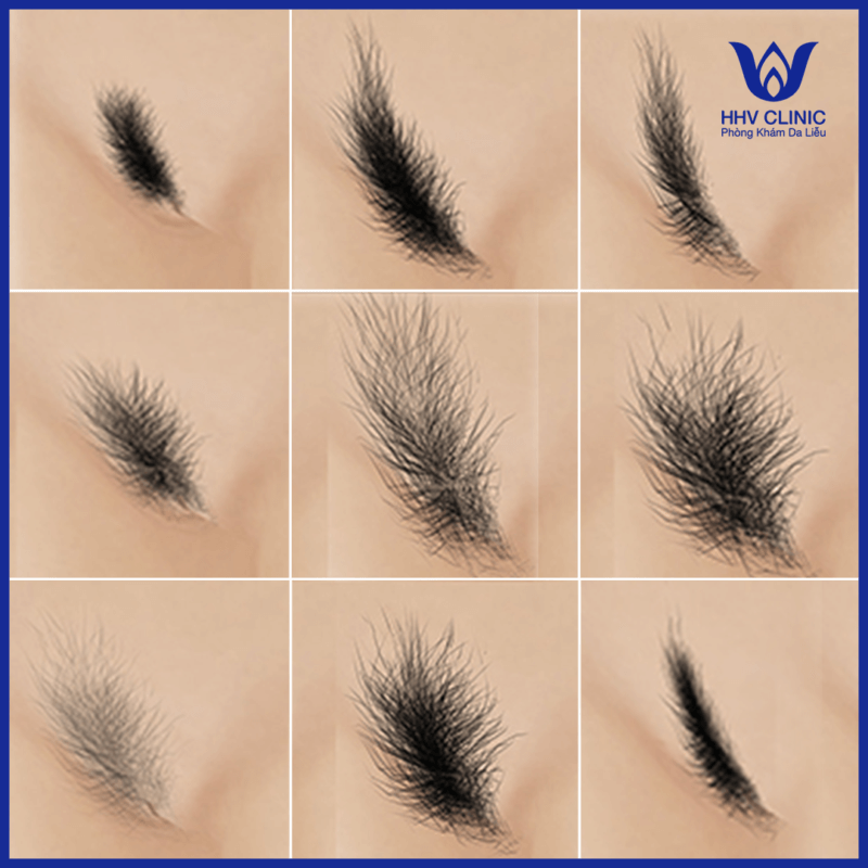 Triệt lông vùng kín