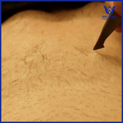 Nhổ lông bikini bằng nhíp dễ gây viêm nang lông