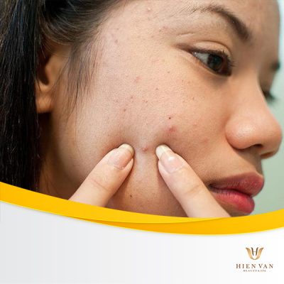 Tự nặn mụn gây thâm mụn