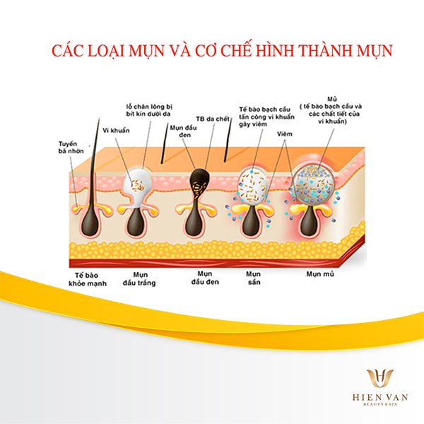 cơ chế khoa học hình thành nên mụn trứng cá