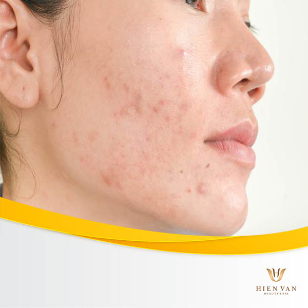 có cần phải xử lý hết nhân mụn trước khi điều trị mụn không?