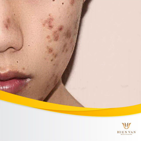 Đốm nâu sẽ xuất hiện nếu triệt lông không đúng cách