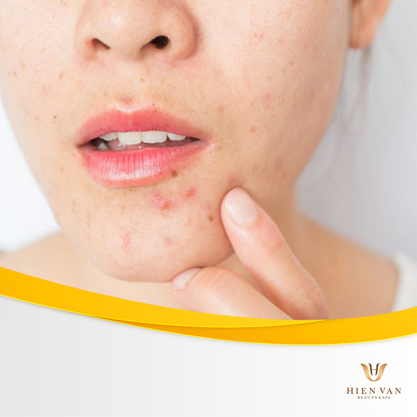 một số hạn chế khi áp dụng đắp mặt nạ từ thiên nhiên tại nhà