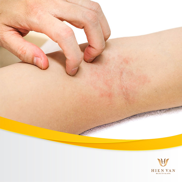 Mẩn đỏ kích ứng là biểu hiện thường thấy của triệt lông tại nhà