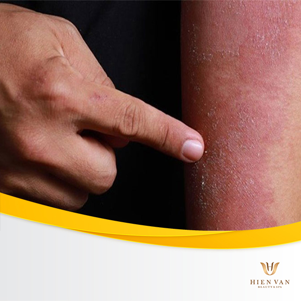 Khô da kết vảy là một trong những triệu chứng của triệt lông không đúng cách