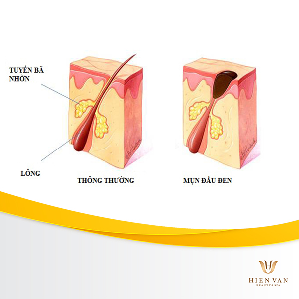 mụn đầu đen là gì?