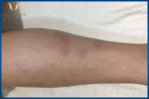 trị sẹo thâm sau bỏng