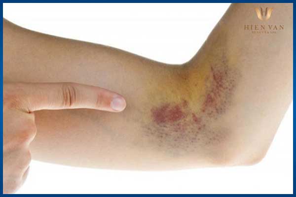 trị sẹo thâm sau tai nạn