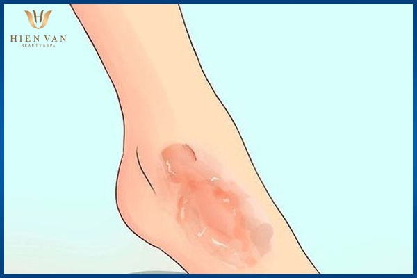 trị vết thâm bỏng