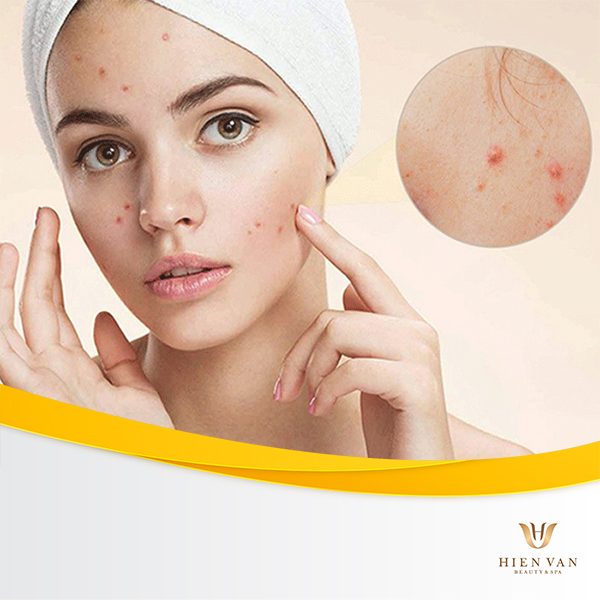 mụn trứng cá ghé thăm do đâu