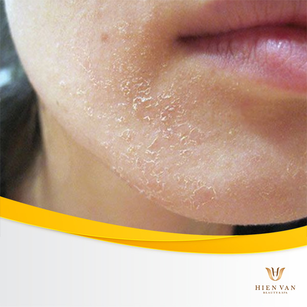 Khoảng 2-4 tuần dùng rượu thuốc, da sẽ đỏ và bong