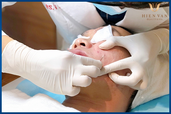 bóc tách đáy sẹo