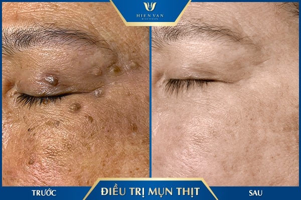 điều trị mụn thịt quanh mắt hiệu quả