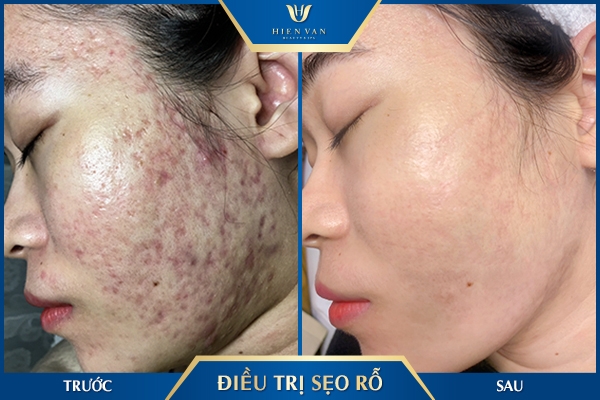 điều trị sẹo rỗ