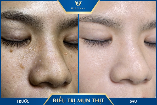 cách chữa mụn thịt ở mắt