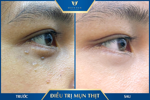 đốt mụn thịt quanh mắt tại spa