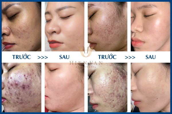 trị sẹo lõm hiệu quả