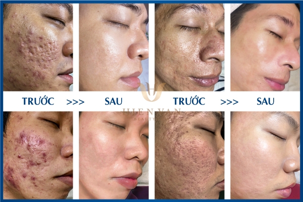 trị sẹo rỗ tận gốc