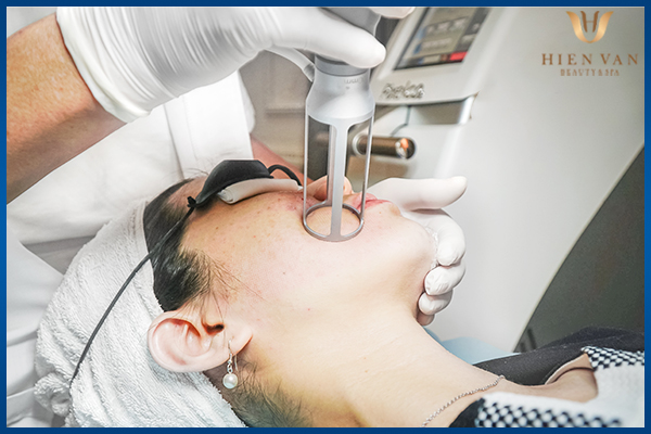 cách trị sẹo rỗ lâu năm bằng laser pixel co2