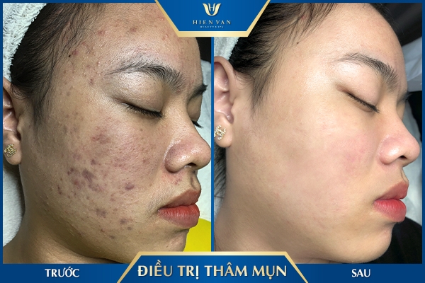 cách trị thâm mụn tại spa