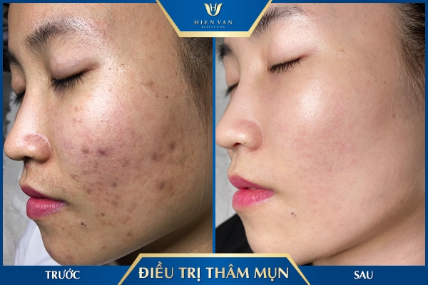 có nên đi spa trị thâm mụn