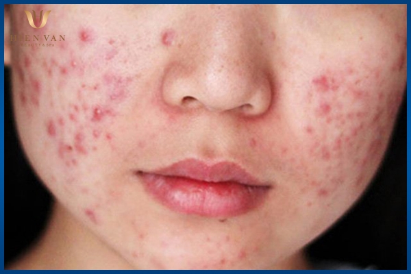 Phân biệt thâm mụn và thâm sẹo