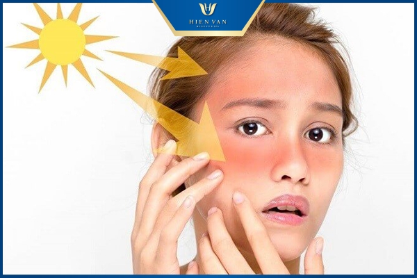 Tia UV nguyên nhân gây mụn thịt