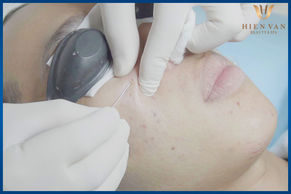 trị sẹo rỗ lâu năm bằng Bóc tách đáy sẹo