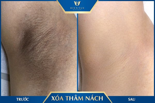 trị thâm nách hiệu quả