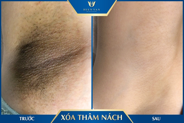 trị thâm nách spa