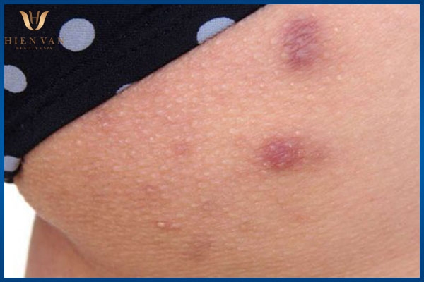 Bị mụn nhọt ở mông