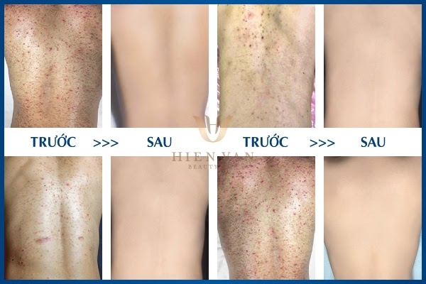 trị mụn lưng tại spa