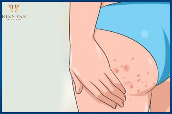 cách trị thâm ở mông