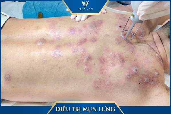 Điều trị mụn lưng tại spa