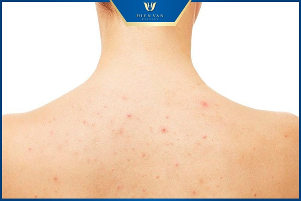 Mụn lưng ẩn li ti