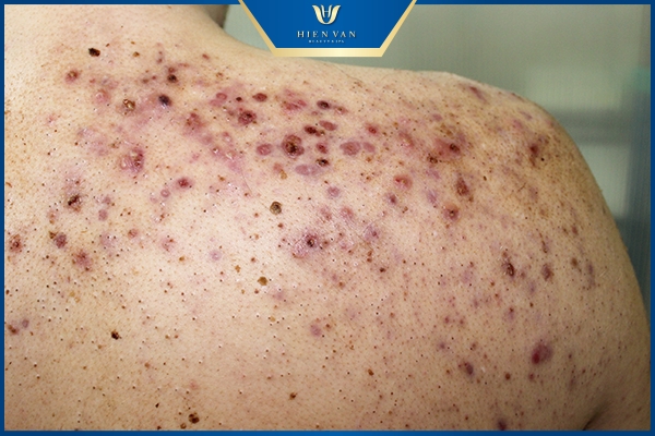 mụn lưng dày sừng nang lông