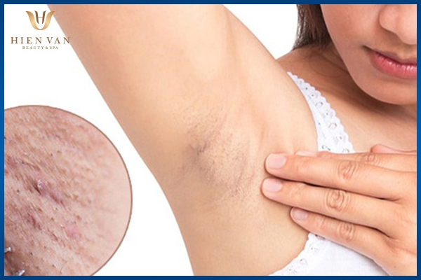 nguyên nhân thâm nách