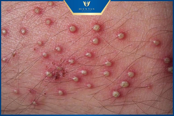 Viêm nang lông mụn lưng