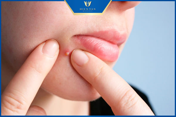 Làm sao để hết mụn