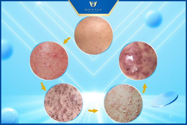 Làm sao để hết mụn