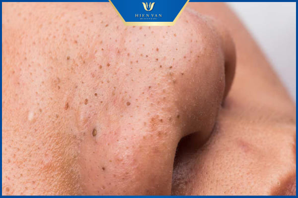 Cách trị mụn trứng cá