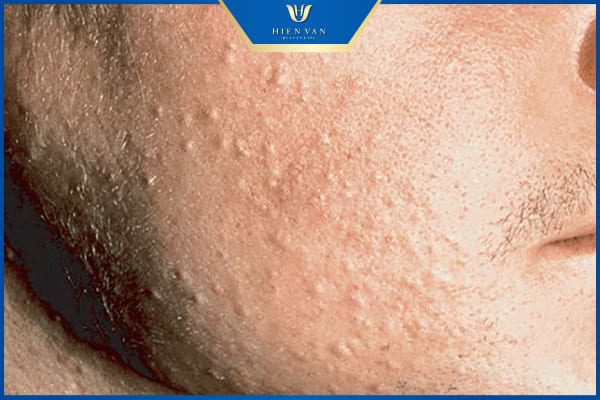 Cách trị mụn trứng cá