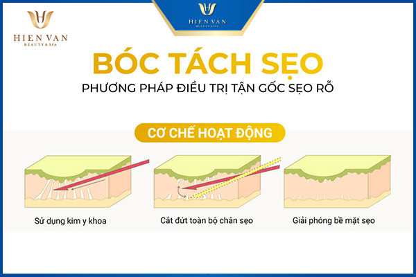 Cách trị sẹo