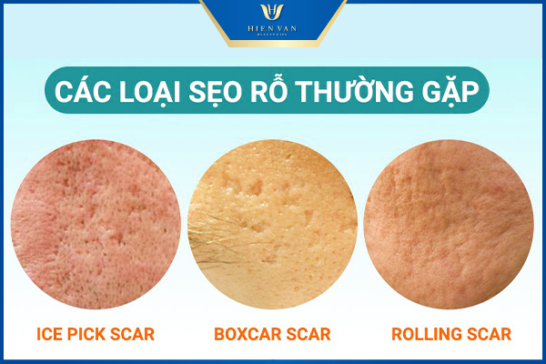 Cách trị sẹo rỗ