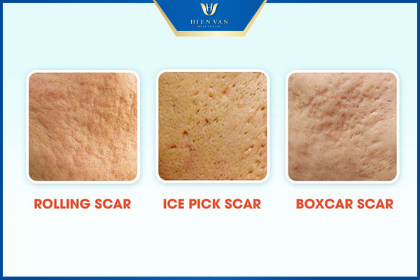 Cách trị sẹo rỗ