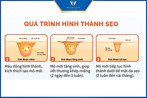 Cách trị sẹo rỗ