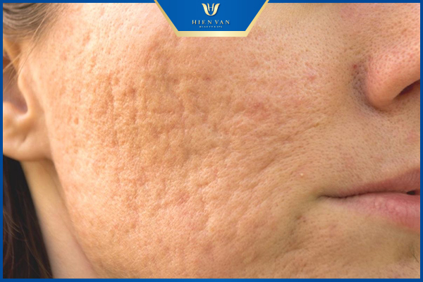 Cách trị sẹo rỗ